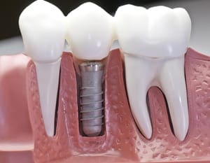 implant-crowns-01 Whiten Teeth Arlington TX | Mouth Makeover | Teeth in a Day