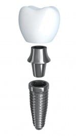 bigstock-Tooth-Implant-Disassembled-37298293 Shown above is the implant, abutment and crown.