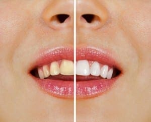 teeth before and after whitening teeth whitening